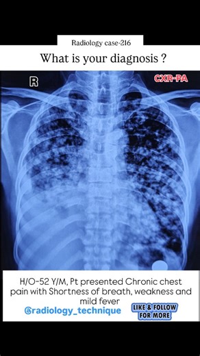 Radiology case-216 A 52 year male patient presented chronic chest pain with Shortness of breath, weakness and mild fever.. What is your diagnosis..? #viralreels #reels #radiographer #medico #radiology #reelsinstagram #mbbs #xray #medicos #medicogirl #medico #mbbsstudent #mbbs #pulmonary #pulmonologists #radiologia #lung #cxr #lungdisease #lunges #tuberculosis #tb #chest | Diwakar Patel