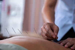 Acupuncture gets boost in NIH-funded study