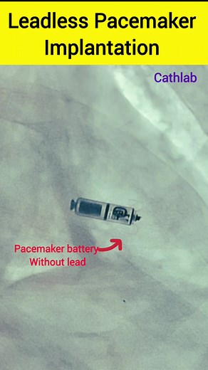 Leadless Pacemaker implants #Pacemaker #pace #heartblockage #HeartBlock #heartcare #cardio #cardiology #cardiovascular #cardioworkout #CardiovascularHealth #heart #heartattack #hearthealth #heartbeat #reels #reelsviralシ #viralreels #fbreels #fbreelsvideo #reelsvideo #reelsfb #explorepage | Sonu Sharma