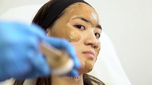 Depigmentation Melasma Treatment / Cosmelan Peel / Asian Female Skin / Post Inflammatory Hyperpigmentation
