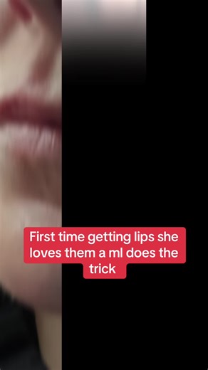 Getting Lip Fillers: A First-Time Experience