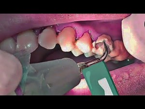 Teeth tartar removal
