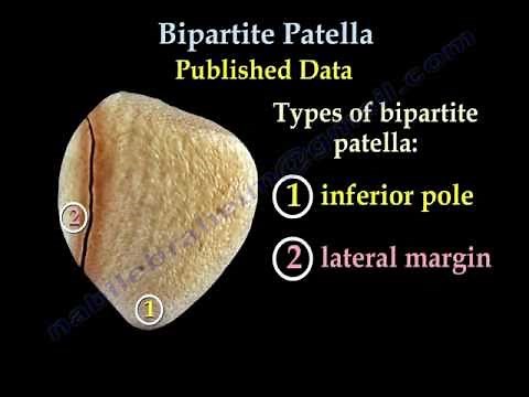 Bipartite Patella - Everything You Need To Know - Dr. Nabil Ebraheim