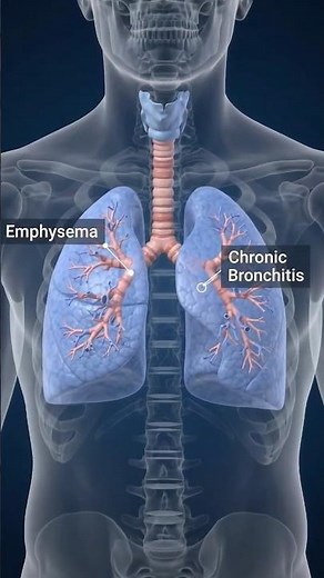 Understanding COPD: Symptoms, Causes & How to Protect Your Lungs 🫁 (Must Watch!) #copdawareness