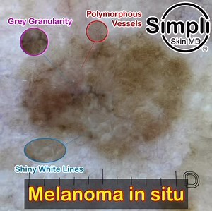 Melanoma in situ arising in nevus. Dermoscopy shows grey granularity, polymorphous vessels (dotted, comma) and orthogonal shiny white lines arising in a background irregular pigment network. Skin checks are vital! Music Credit: Roonin - Missing You | Simpli Skin MD