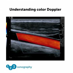 3K views | Look at this longitudinal view of a carotid artery with...