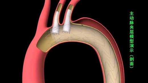 主动脉夹层TEVAR激光原位双开窗