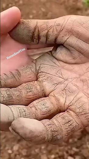 Get Rid Of Extremely Dry Cracked Hands| Hand Moisturizer For Soft & Supple Hands | #shorts #viral