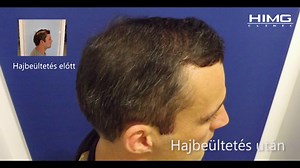 Péter hajbeültetési eredménye a HIMG Klinikán