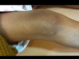 Dislocation of Patella