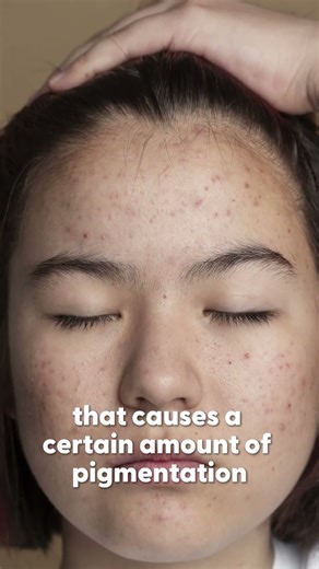 The Truth About Pigmentation No One Tells You