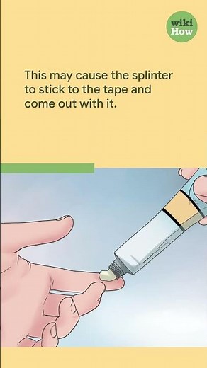 How to Get a Splinter Out #shorts