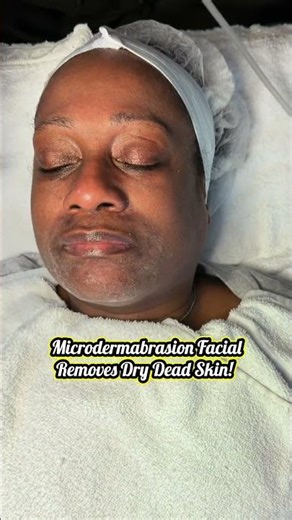 Microdermabrasion for dry skin! #hyperpigmentation #dryskin