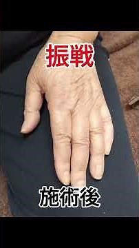 パーキンソン病『振戦』（70代女性） #パーキンソン病 #振戦