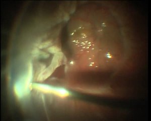 Close Funnel Retinal Detachment - Eyetube