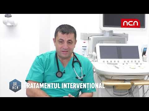 Marius Andronache, medic cardiolog - Fibrilatia atriala si tratamentul prin ablatie