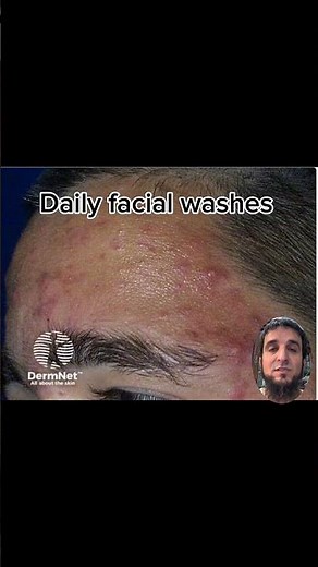 Acne Treatment Explained in 60 Seconds | How to Clear Acne Fast #acne #acnetreatment #acnedoctor