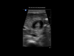 Projectile Vomiting x 2 days in 2 month old Baby Girl