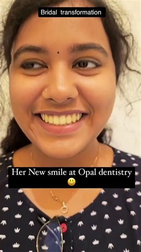 Bridal Smile Transformation of Preetha with Invisalign | Proclination Correction by Dr. Kirubaharan