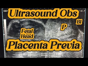 Placenta Previa: Tips and Insights from Moms | Understanding Placenta Previa | Obs Scan