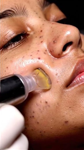 Extreme Blackhead Removal ASMR