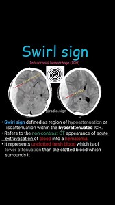 #MRA #Radiology #cerebral #mri #brain #lesions #signs | CT Scan and MRI study