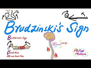 Brudzinski's Sign,Signs of Meningitis,How to perform SOMI?