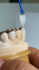 Amazing thin ceramic veneers! From Dr.Anne Fabricius in Colorado! | CEO Luke Kahng