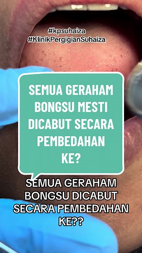 @Klinik Pergigian Suhaiza #fyp #fypシ #longervideos #longervideo #gigi #doktorgigimalaysia #doktorgigi #dentist #rawatangigi #dental #dentaltreatment #sakitgigi #gigiberlubang #gigi #tampalgigi #tampalgigimurah #toothfilling #compositefilling #sahabatnr #teamrealsupporteraurasifu #mizzbaeynclub #sahabatbosskay #gigigeraham #gigicantik #karies #kariesgigi #dentalcaries #dentalcaries #teeth #gusiberdarah #gosokgigi #dentalsurgeon #doktortiktok #klinikpergigian #klinikpergigiansuhaiza #gigigerahambo