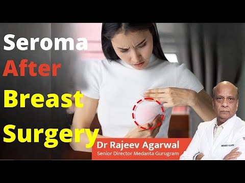 Seroma Formation of Breast Surgery By Dr. Rajeev Agarwal | Seroma After Breast Surgery