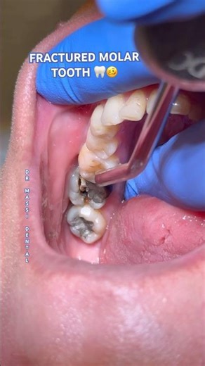 FRACTURED MOLAR TOOTH 🦷😬