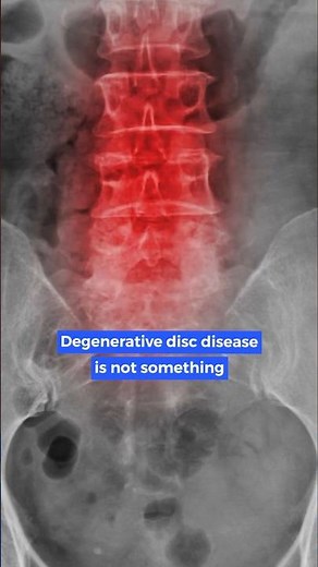 Surgery for Degenerative Disc Disease?
