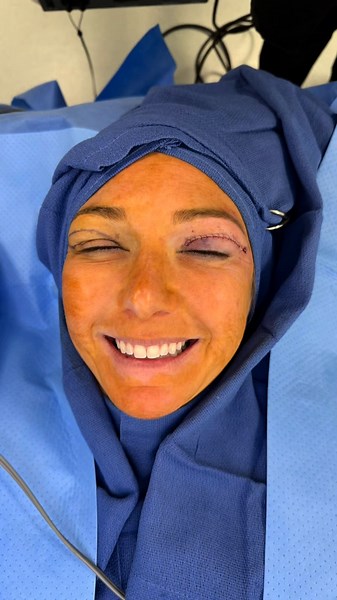 Last Minute Upper Blepharoplasty Procedure Overview