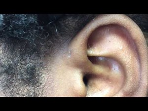 Congenital Pre-auricular Fistula