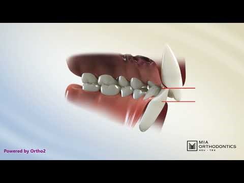 Deep Bite vs Normal Overbite: What’s the Difference?
