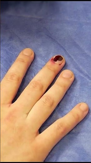How To Trephine A Nail