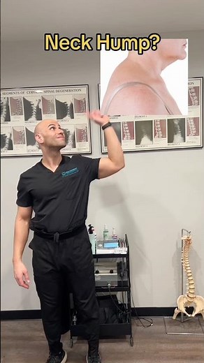 Neck hump? Try this and share! Neck humps can have various causes such as Cushing’s Syndrome.