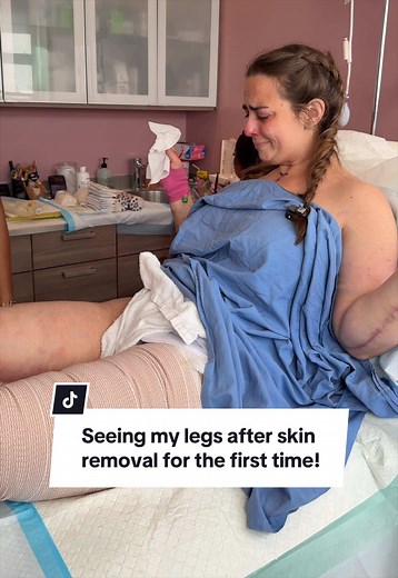 It’s hard to know what to expect emotionally when you see your surgery results for the first time. But with @modernplasticsurgery, who truly goes above and beyond, you know it’s going to be life-changing either way. Sometimes the change is drastic, and sometimes it takes time to fully see because of swelling. For my first few appointments, I only had the chance to see my legs unwrapped while lying on the table, not standing. There’s still a significant amount of swelling too. But even with that,