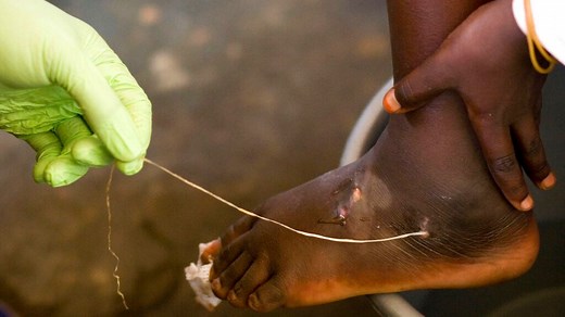 Guinea worm cases drop to 14 – close to Jimmy Carter’s goal of 0