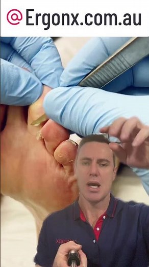 Say Goodbye to Corns: Podiatrist's Expert Removal Tips #FootCare #Podiatry