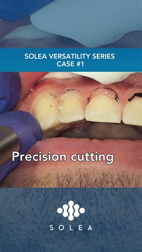 Solea® Versatility Series Case 1: Esthetic Gingivectomy