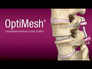 Spineology: OptiLIF® with the OptiMesh® Expandable Interbody Fusion System