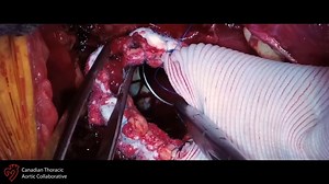 M - Repair of acute type A dissection with distal malperfusion using a novel hybrid arch device
