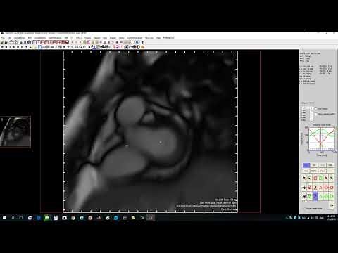 How to calculate bi-ventricular functions & volumes by segment?