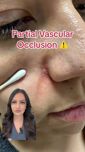 A vascular occlusion is when blood stops flowing through a blood vessel due to a vascular blockage. There may be a reduction in blood flow due to a total or partial obstruction. • A vascular occlusion can be brought on by an external compression, an internal obstruction like a blood clot, or a foreign body like filler material. • If left untreated, a vascular occlusion of a blood vessel supplying the skin can result in skin necrosis and tissue death. • Signs and symptoms include (but are not lim