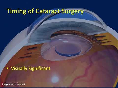 Cataract Surgery and Intraocular Lenses