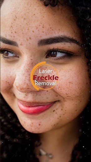 ✨Laser Freckle Removal💥‪@DermaVue‬ #freckles #freckle #frecklestreatment
