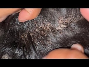 Love vs Lice: Wife Takes on Husband’s Hair 🐜💇‍♀️ ||Head lice treatment-Lice picking ASMR||EPISODE 98