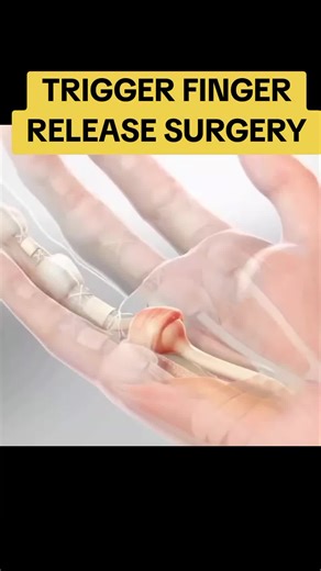 Trigger Finger Release Surgery Explained 🖐️ | Pain Relief in Minutes Trigger finger causes painful locking and stiffness—but this quick, minimally invasive release surgery helps restore smooth finger movement and long-term relief. Watch how doctors fix it and why thousands choose this procedure every year in the USA. #TriggerFinger #HandSurgery #MedicalAnimation #usahealthcare #USAHealthcare