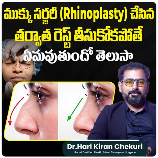 How Long Until You See Results After a Nose Job? Complete Guide Curious about how long it takes to fully heal after a nose reshaping surgery (rhinoplasty)? 🕒 Dr. Harikiran Chekuri, one of Hyderabad’s most trusted plastic surgeons, breaks down the rhinoplasty recovery stages — from swelling and bruising to final results. At ReDefine Plastic Surgery & Hair Transplant Center, we offer personalized care and advanced techniques to ensure a smoother, faster recovery. 👨‍⚕️ Consult the Expert: 📍 Dr. 